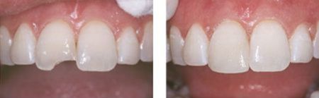 Before-and-after photos showing how a patient's front tooth (and smile) is completely restored through dental bonding. Dental bonding is one of our cosmetic dentistry services.