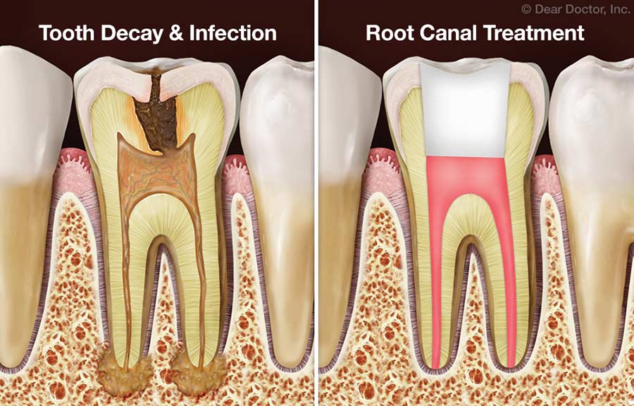 Side-by-side digital rendering showing the inside of an infected tooth before and after root canal treatment. An infected tooth is one form of dental emergency.