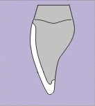 Drawing of a porcelain veneer that fits snugly over the tooth with a flush margin. Treatment with veneers requires minimal tooth preparation to provide a flush margin.