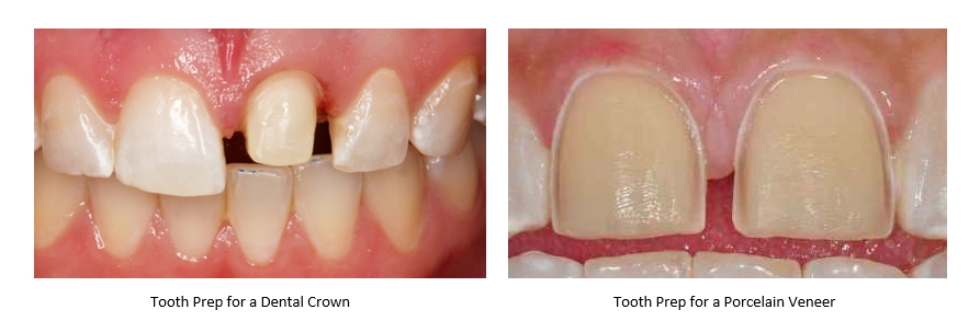 Side-by-side photos show the amount of tooth structure removal required for treatment with crowns versus with porcelain veneers.