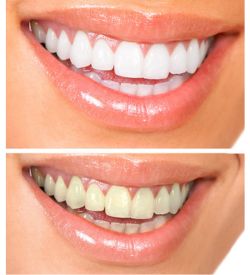 Before-and-after photos of a woman's smile show the difference teeth whitening makes. Teeth whitening is one of the cosmetic dentistry services we provide.