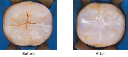 Photos of a molar before and after treatment with a preventive sealant. The general dentists at Mountain View Family Dental provide preventive care and basic treatment to pediatric patients.