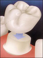 a drawing of a porcelain crown being fitted onto a prepared tooth