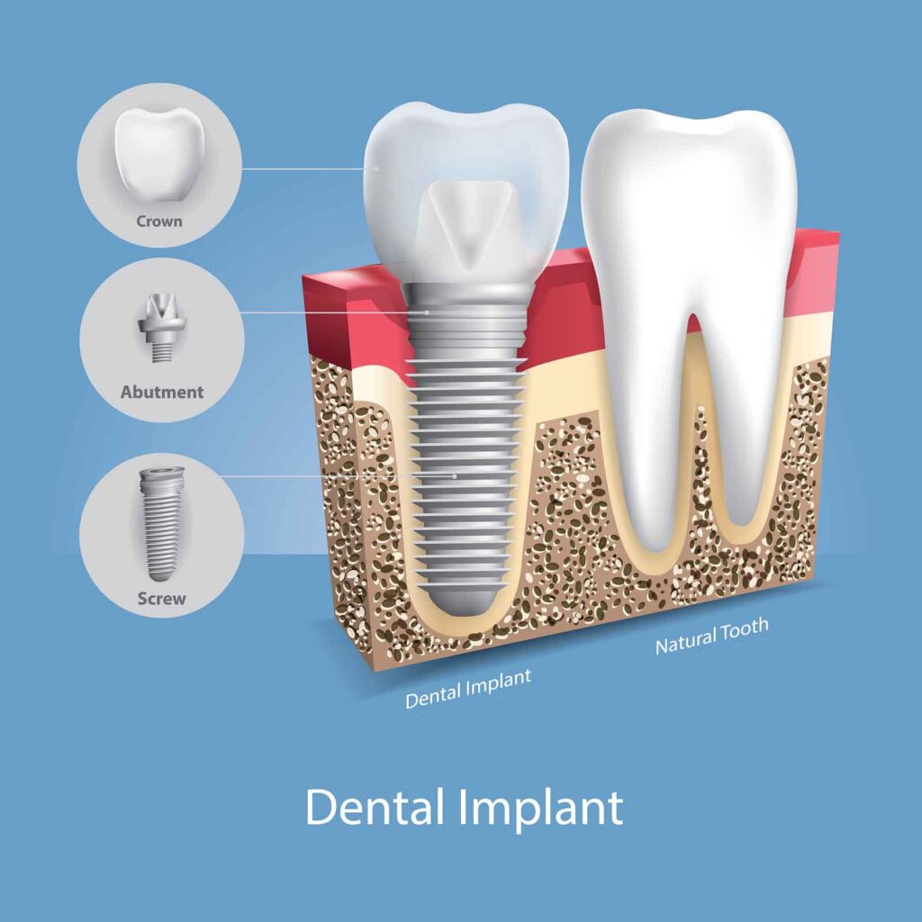 Drawing of a dental implant showing all of its components. Implants consist of crowns, abutments, and fixtures.