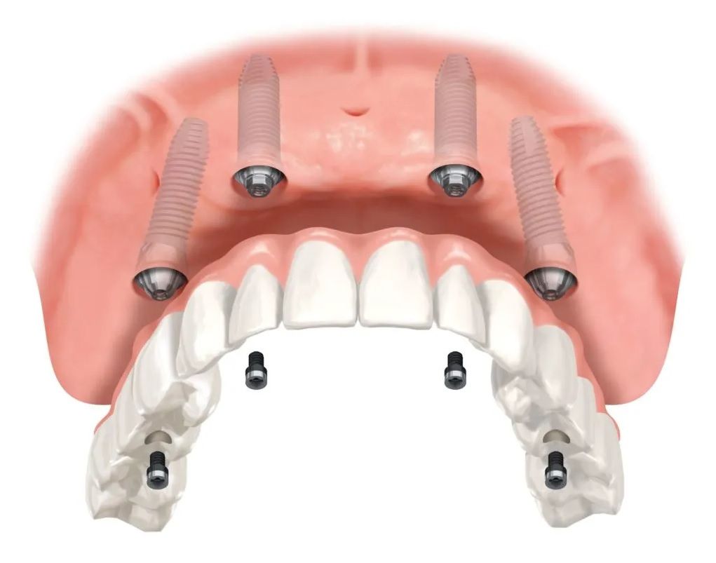 Drawing of an upper arch of fixed implant-supported dentures.