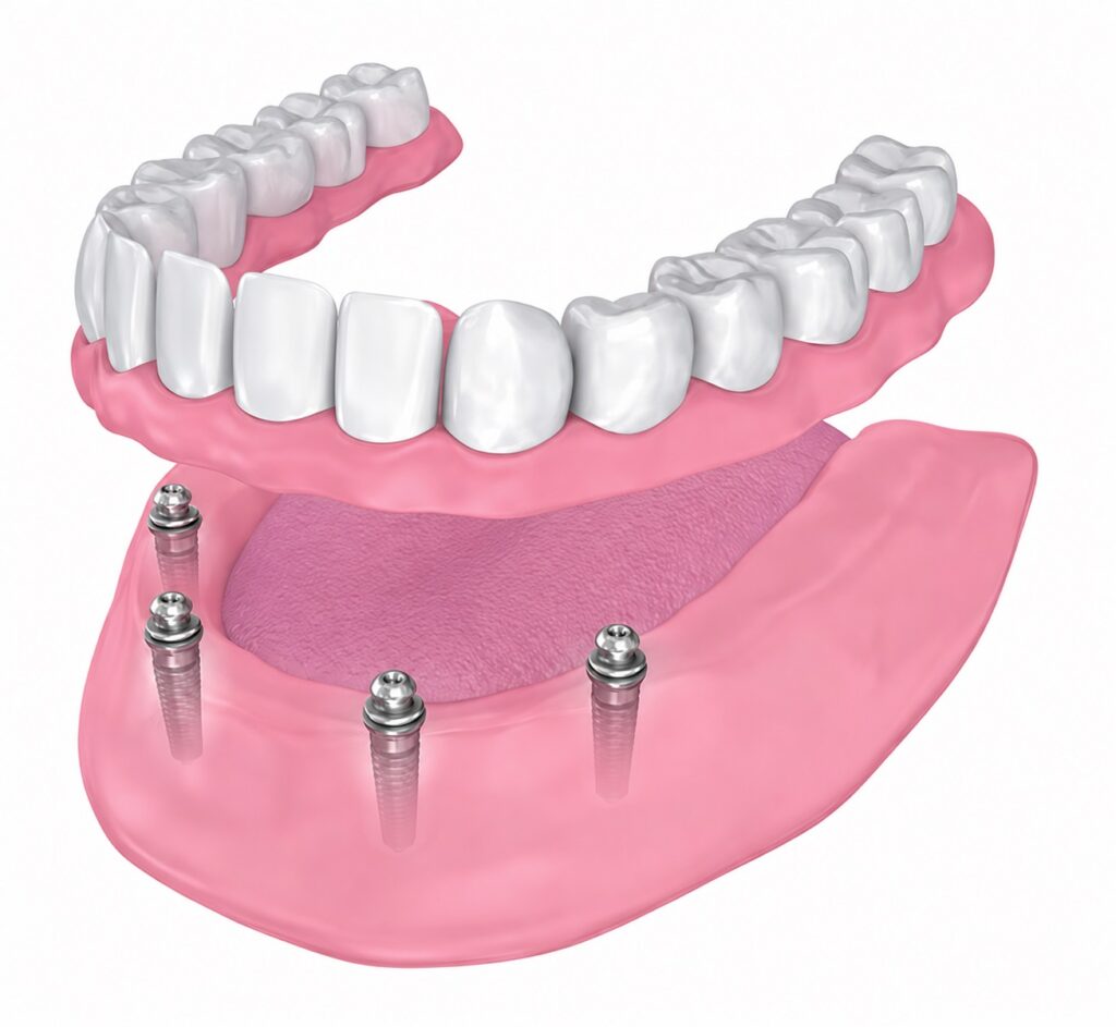 3D rendering of a lower arch of implant-supported overdentures.