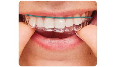 A woman places a ClearCorrect aligner into her mouth. The photo shows the flat trimline that gives the aligner more predictable results than scalloped aligners like Invisalign.