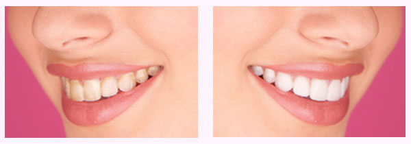 Side-by-side photos showing a woman's smile before and after teeth whitening.