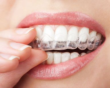 Close-up photo of a woman placing a clear plastic whitening tray over her teeth.