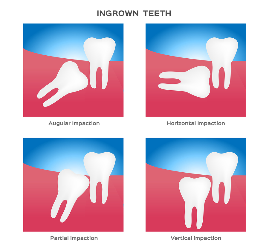 Diagram that shows four types of impaction for wisdom teeth.
