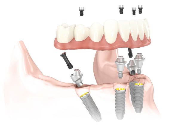 Rendering of a lower denture being affixed to four implants placed according to the All-on-4 method.