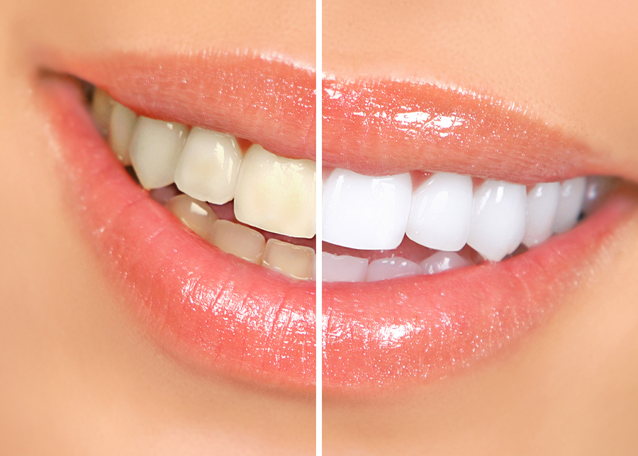 Before-and-after photos of a woman's smile show the difference teeth whitening makes. Teeth whitening is one of the cosmetic dentistry services we provide.