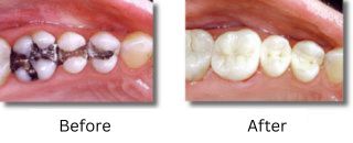 Side-by-side photos of a patient's teeth before and after amalgam fillings were replaced with composite ones. Sanitary amalgam removal is a part of holistic dentistry.