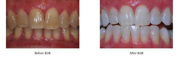 Photos showing a smile before and after treatment with KöR Whitening.